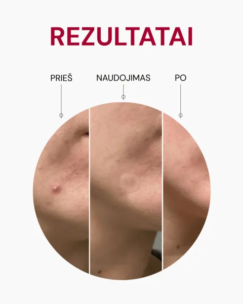 ODA PRO pleistrai nuo spuogų su azijinės centelės ekstraktu