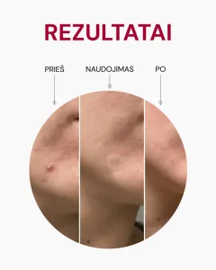 ODA PRO pleistrai nuo spuogų su azijinės centelės ekstraktu